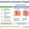 Анальна тріщина: чому так сильно болить і чому мазі самі по собі не допомагають